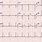 Sinus Rhythm 12 Lead ECG