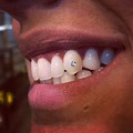 Teeth Jewelry Jonesboro AR