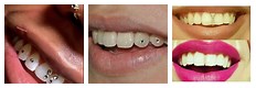 Teeth Jewelry for Women