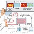 What Is Kidney Dialysis