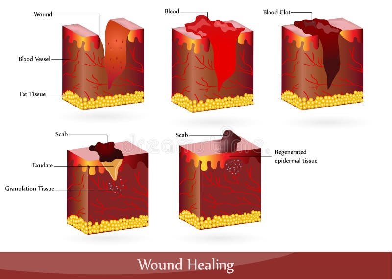 Wound healing