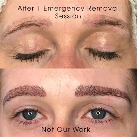 Permanent Makeup Removal