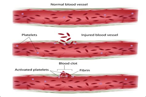 Treatment of Afibrinogenemia in Ayurveda