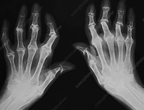 Arthritic hands, X-ray - Stock Image M110/0679 - Science Photo Library