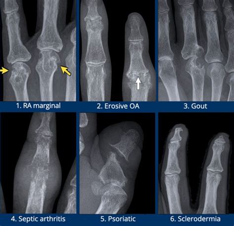 Rheumatoid Arthritis X Ray Knee