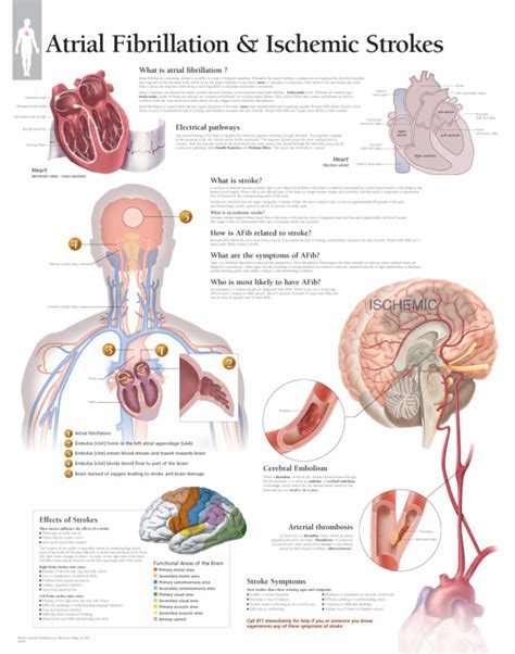 Atrial Fibrillation and Ischemic Strokes | Scientific Publishing