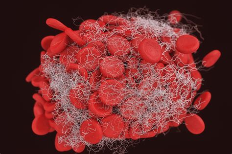 Blood Clots: What You Should Know | UPMC HealthBeat