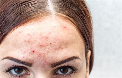 Hormonal Acne: Causes, How To Treat It, And Foods To Avoid