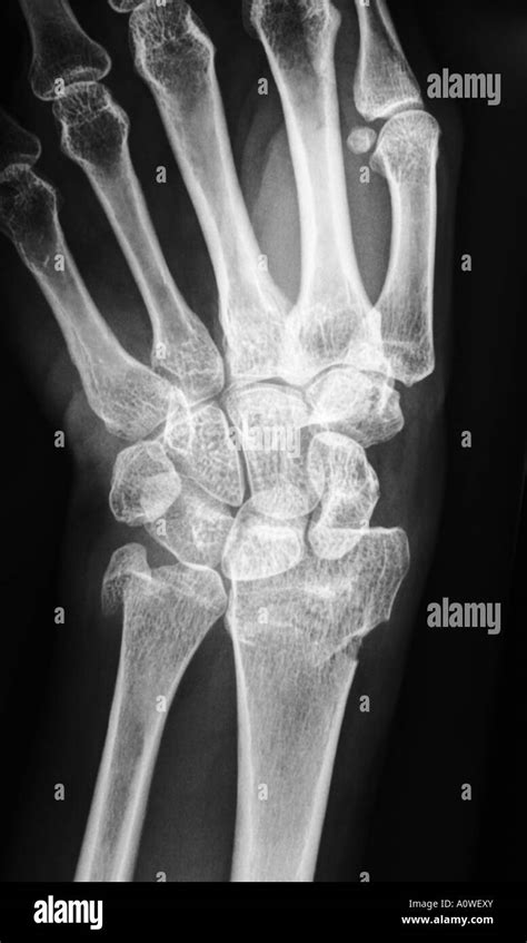 X Ray of human hand with broken wrist, fracture of radius, xray, casualty surgery Stock Photo ...