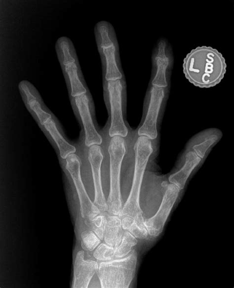 What does hand arthritis look like on x-ray? - John Erickson, MD