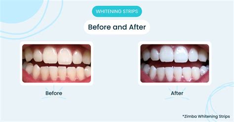 The Best Teeth Whitening Strips To Use at Home