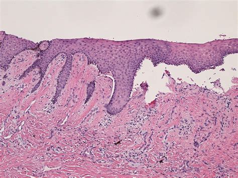 Mucous Membrane Pemphigoid Histology