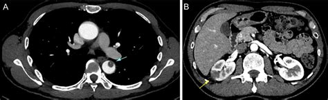 Figure 1 from Endovascular Treatment for Lower-extremity Arterial Thrombosis in a Patient with ...