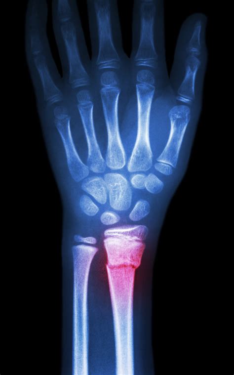 Can You Always See a Fracture in an X-Ray? | University of Utah Health