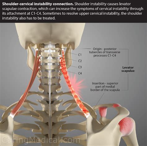 Neck And Shoulder Pain Switching Sides - mapageprek