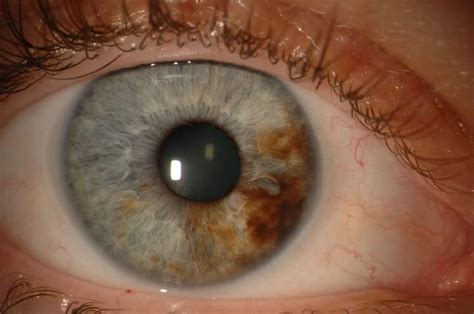 Extremely rare form of eye cancer: diffuse iris melanoma. A freckle from the eye which turned ...