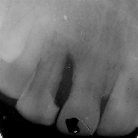 Figure 1 from Diagnosis and non-surgical periodontal management in congenital afibrinogenemia ...