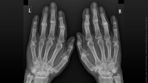 Rheumatoid Arthritis Hands X Ray