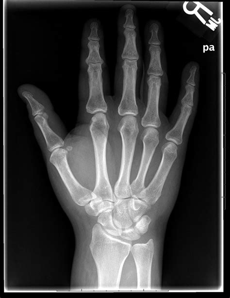 Right Hand X Ray Normal