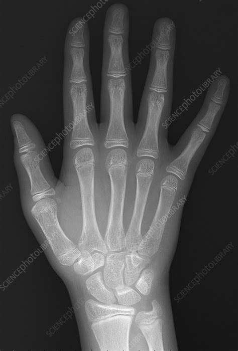 Normal hand of 13 year old, X-ray - Stock Image - C039/3338 - Science Photo Library