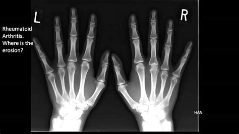 Rheumatoid Arthritis Hands X Ray