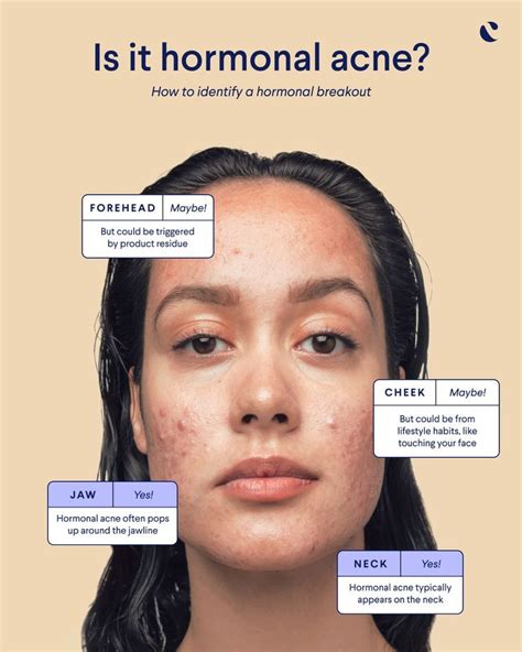 Everything you need to know about hormonal acne | Hormonal acne, Acne treatment, Jawline acne