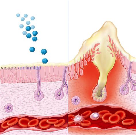 Biomedical illustration of healthy nasal mucous membrane coming into contact with allergens ...