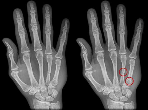 Trauma X-ray - Upper limb gallery 2 - Hand - Boxer's fracture