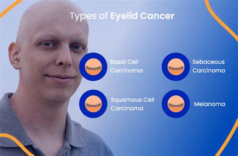 Eyelid Cancer: Everything You Need To Know | ACTC