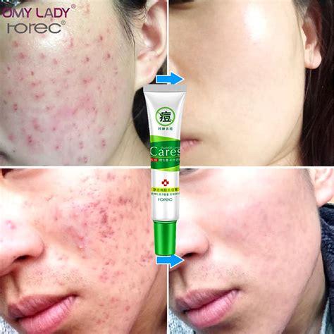 Aliexpress.com : Buy OMY LADY HANCHAN Acne Treatment Moisturizing skin care acne remover face ...