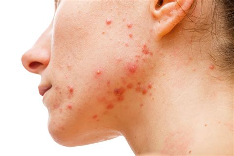 4 Signs You Are Experiencing Hormonal Acne | DermaBlue