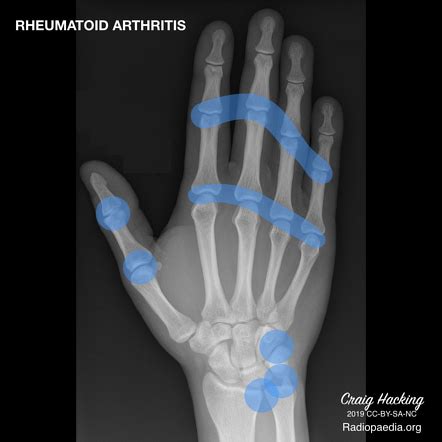 Rheumatoid arthritis | Radiology Reference Article | Radiopaedia.org