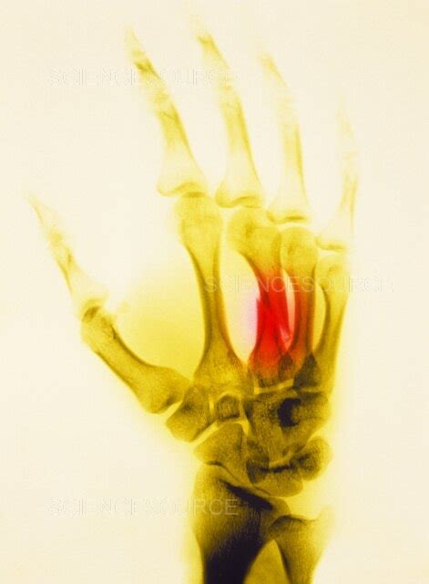 Photograph | Fractured hand x-ray | Science Source Images