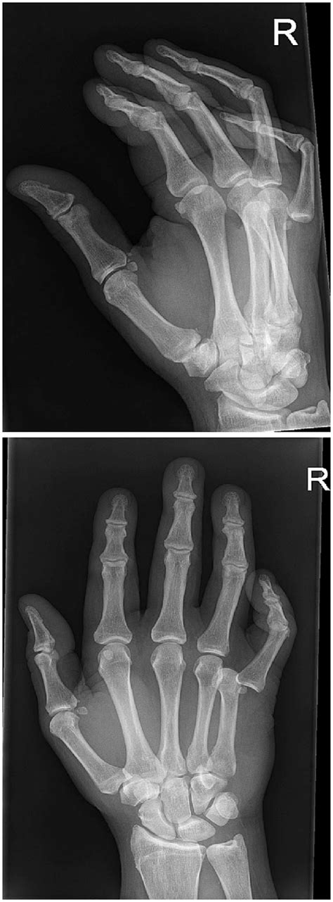 X-ray of the right hand during the examination at the ED. | Download Scientific Diagram