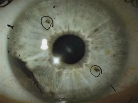 What is ocular melanoma? Medical mystery shines light on rare eye cancer - CBS News