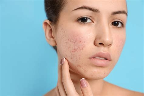 Best Acne Treatment For Sensitive Skin - Reaching World Live