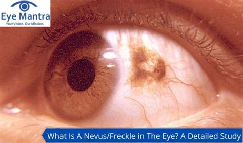 Nevus/Freckle in The Eye | Risk factors of Melanoma Nevi