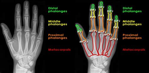 Broken Index Finger X Ray