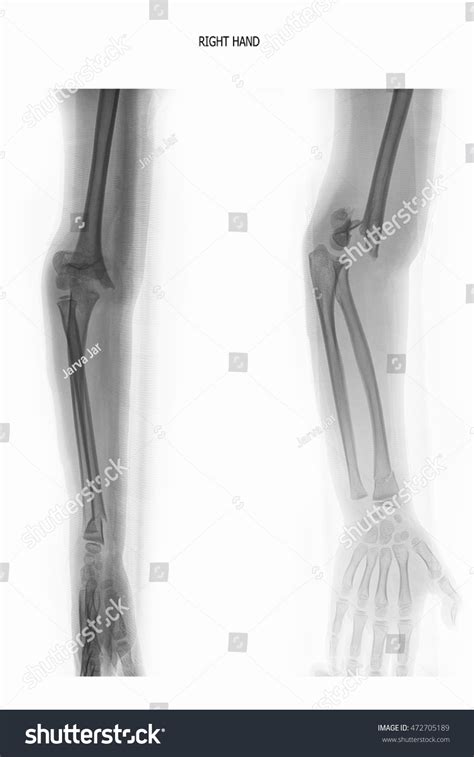 Xray Right Hand Fracture Stock Photo 472705189 | Shutterstock