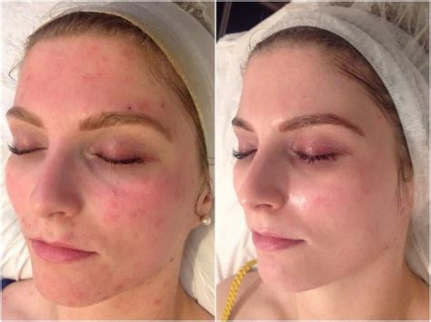 Acne Treatment For Sensitive Skin - Andy Millward - Facialist