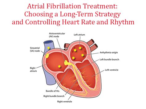 Atrial Fibrillation Treatment: Choosing a Long-Term Strategy and Controlling Heart Rate and ...