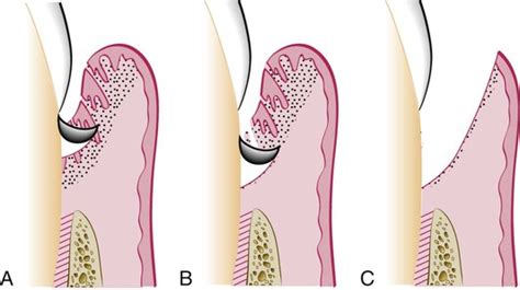 Subgingival curettage; Gingival Curettage; Periodontal Epithelial Debridement