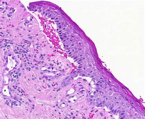 Mucous Membrane Pemphigoid Histology