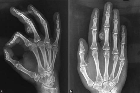 X-ray of the right hand anteroposterior view (b) and oblique view (a)... | Download Scientific ...