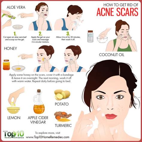 How to Get Rid of Acne Scars | Top 10 Home Remedies