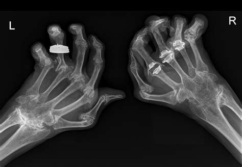 Rheumatoid Arthritis X Ray : Normal vs. Arthritic Joints : What happens in rheumatoid arthritis ...