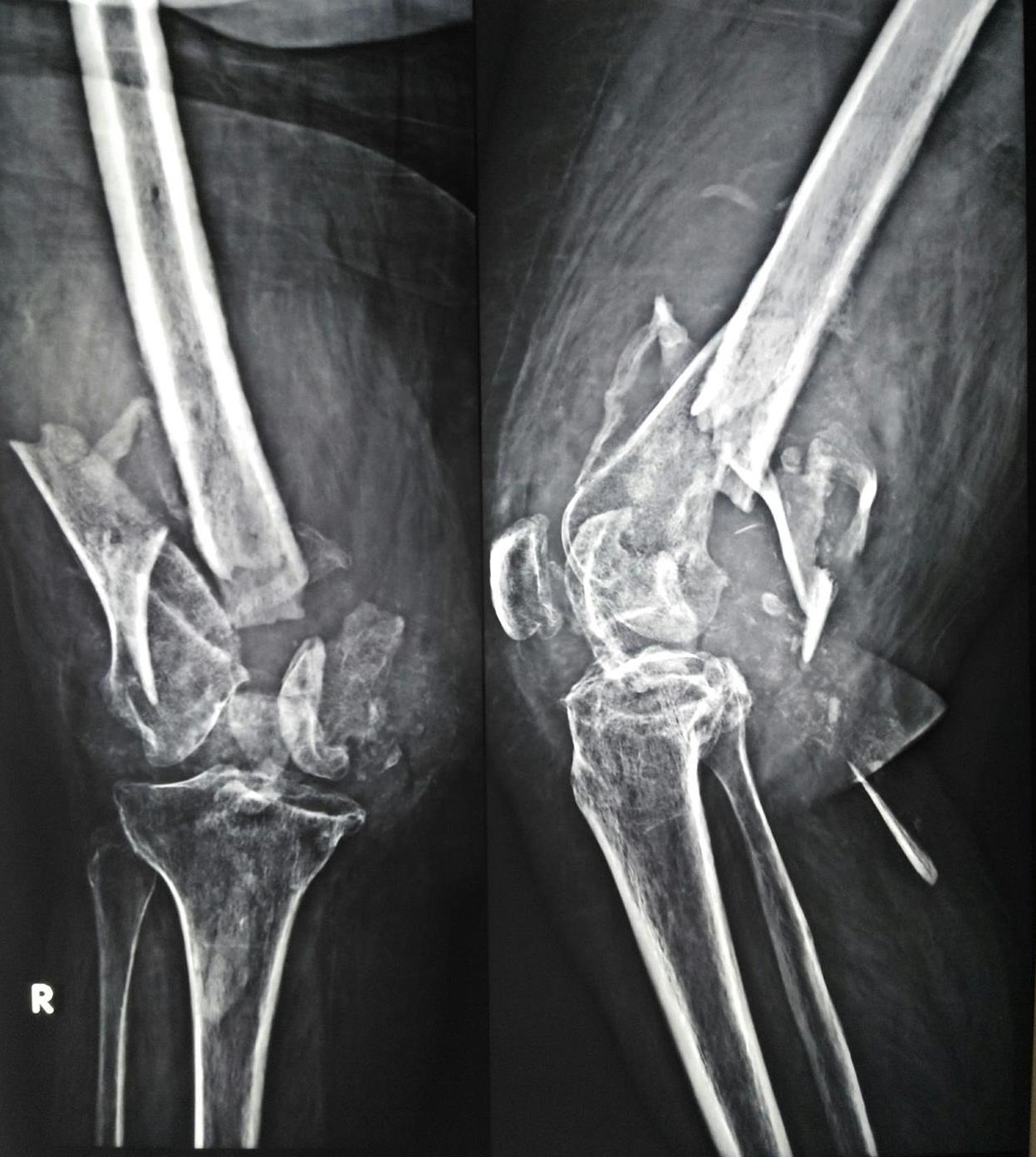 Distal Femoral Fracture