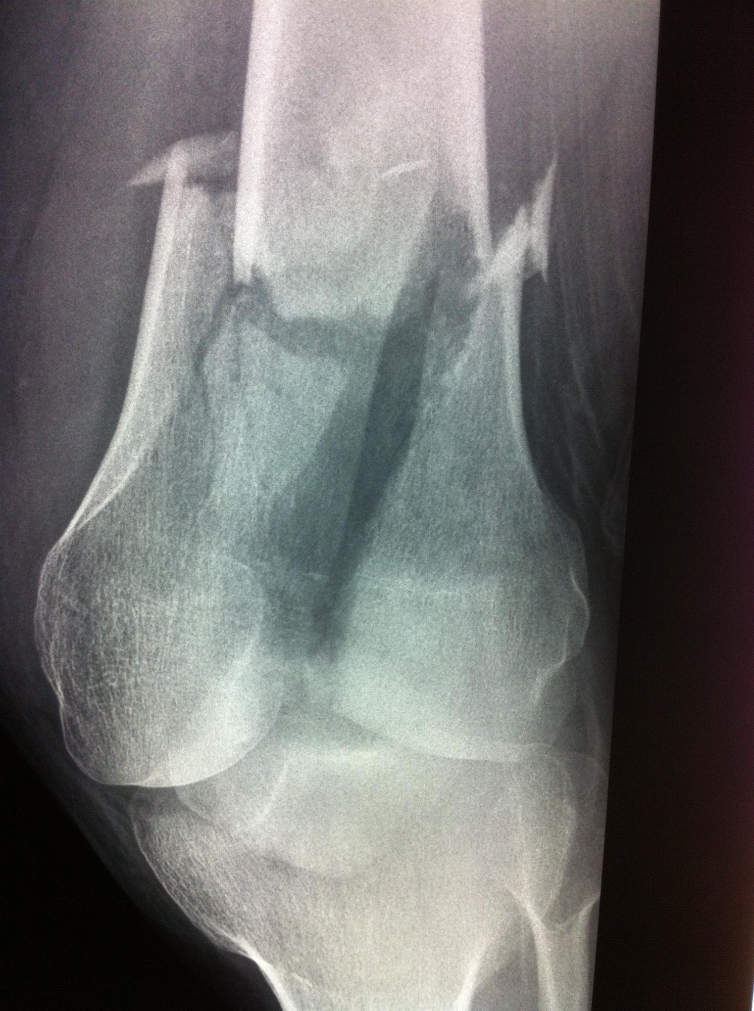 Distal Femoral Fracture