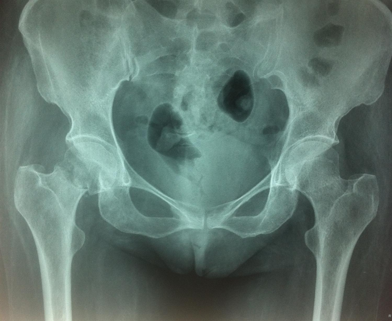 Transcervical Femoral Neck Fracture