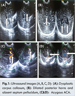 Holoprosencephaly Ultrasound